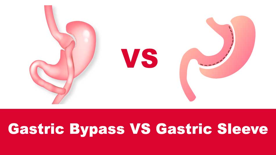 gastric bypass vs gastric sleeve