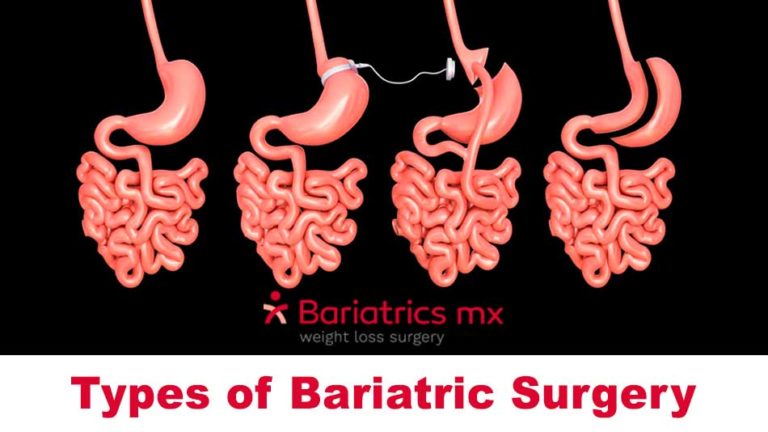 Types of bariatric surgery - types of bariatric surgery for weight loss