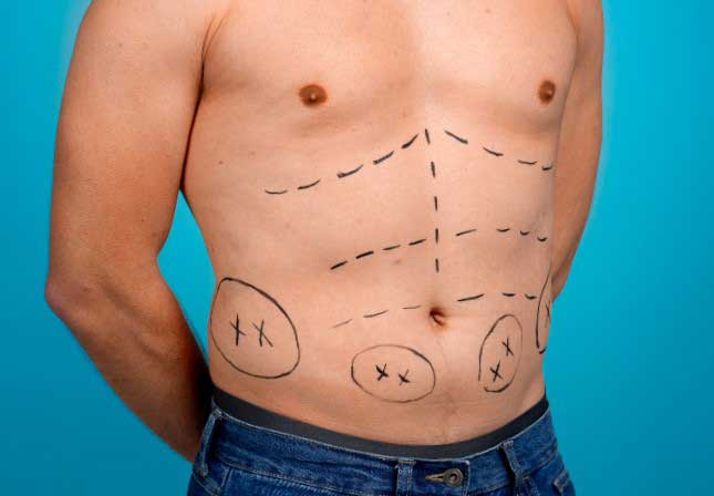 Abdominal Etching (Six Pack Abs)