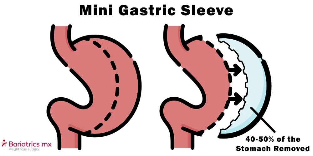 Mini gastric sleeve procedure